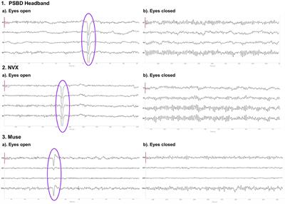 Resting-state EEG recorded with gel-based vs. consumer dry electrodes: spectral characteristics and across-device correlations